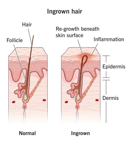 normal hair vs ingrown hair